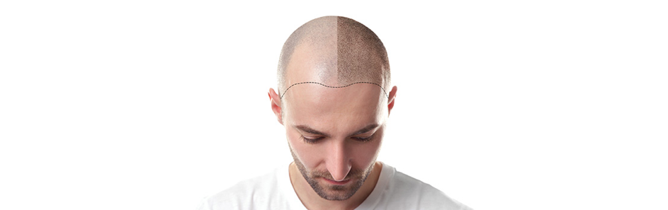 Hair Transplantation Center